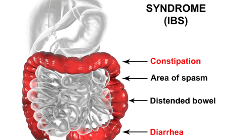 Irritable Bowel Syndrome - "Spastic Colon"